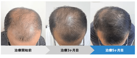 AGA治療経過ビフォーアフタ(AGAヘアクリニック)