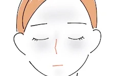 肝斑