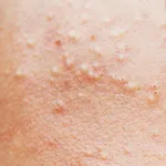 白ニキビ（コメド・面皰（めんぽう））