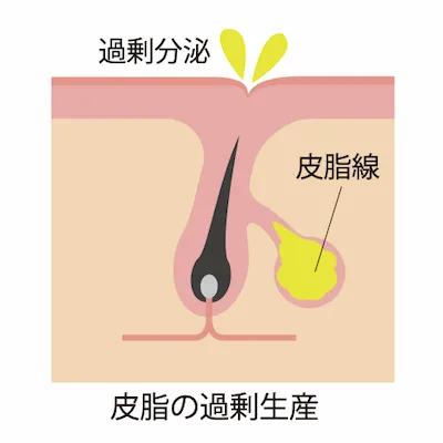 皮脂の過剰生産画像