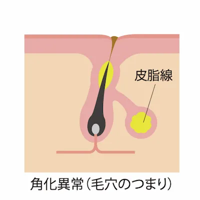 角栓詰まり画像