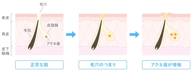 ニキビの原因