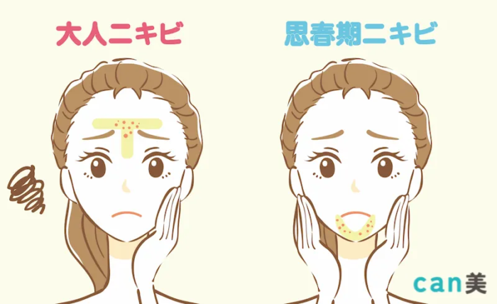 大人_思春期ニキビ違い